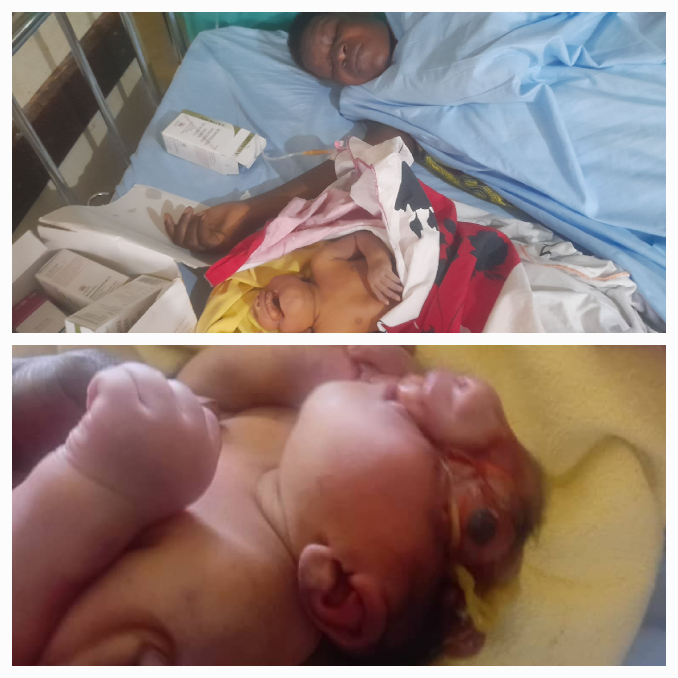 Shock in Pallisa as Woman Gives Birth to Baby with Rare Deformities at Pallisa General Hospital